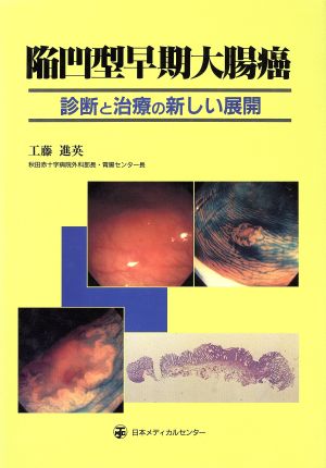 陥凹型早期大腸癌 診断と治療の新しい展開