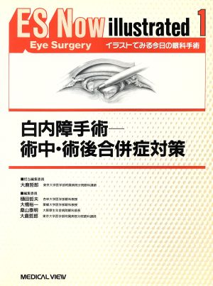 白内障手術術中・術後合併症対策ES Now illustrated1イラストでみる今日の眼科手術1