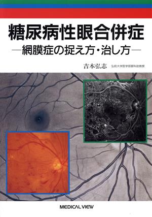 糖尿病性眼合併症 網膜症の捉え方・治し方