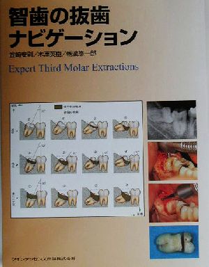 智歯の抜歯ナビゲーション