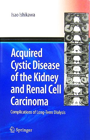 Acquired Cystic Disease of the Kidney and Renal Cell Carcinoma Complications of Long-Term Dialysis