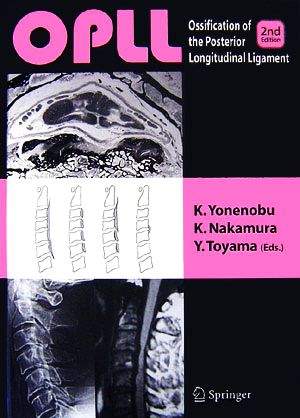 OPLL Ossification of the Posterior Longitudinal Ligament,2nd Edition