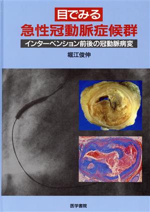 目でみる急性冠動脈症候群 インターベンション前後の冠動脈病変