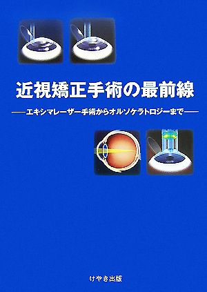 近視矯正手術の最前線 エキシマレーザー手術からオルソケラトロジーまで