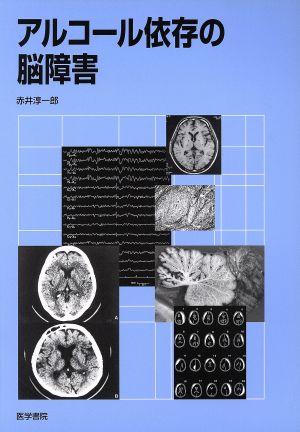 アルコール依存の脳障害