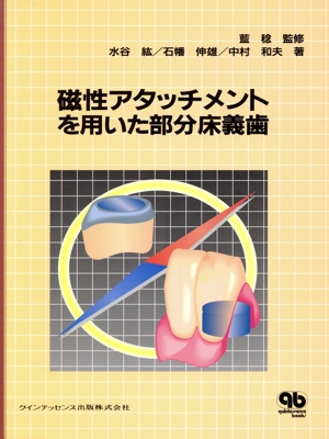 磁性アタッチメントを用いた部分床義歯