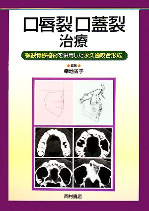 口唇裂口蓋裂治療 顎裂骨移植術を併用した永久歯咬合形成