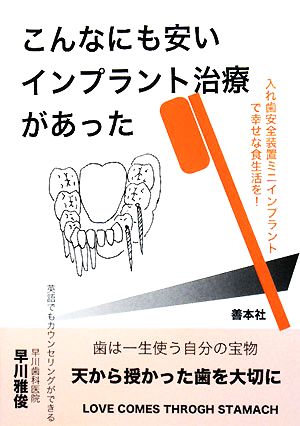 こんなにも安いインプラント治療があった 歯は一生の宝物 入れ歯安全装置ミニインプラントで幸せな食生活を！