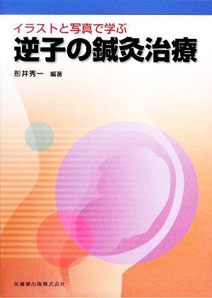 イラストと写真で学ぶ逆子の鍼灸治療