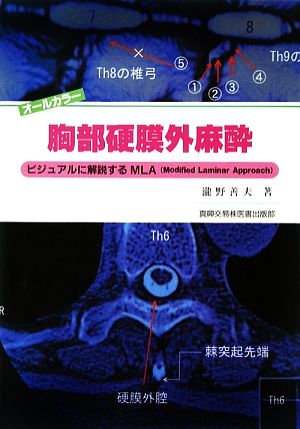 胸部硬膜外麻酔 ビジュアルに解説するMLA