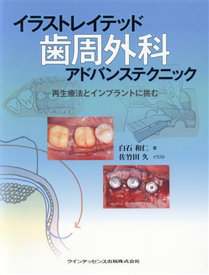 歯周外科アドバンステクニック 再生療法とインプラントに挑む