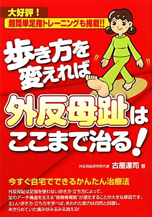 歩き方を変えれば外反母趾はここまで治る！