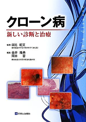 クローン病 新しい診断と治療