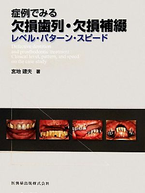 症例でみる欠損歯列・欠損補綴 レベル・パターン・スピード