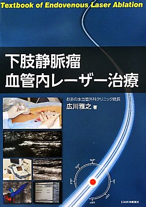 下肢静脈瘤血管内レーザー治療