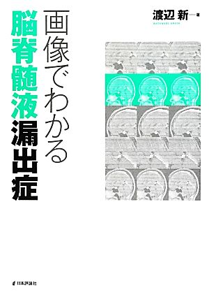 画像でわかる脳脊髄液漏出症