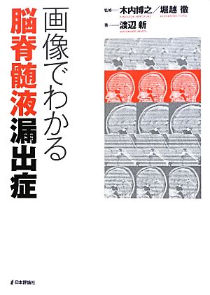 画像でわかる脳脊髄液漏出症