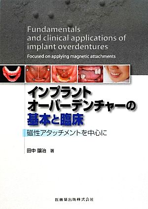 インプラントオーバーデンチャーの基本と臨床 磁性アタッチメントを中心に