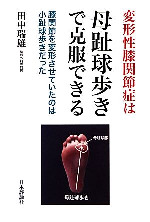 変形性膝関節症は母趾球歩きで克服できる 膝関節を変形させていたのは小趾球歩きだった