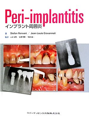 Peri-implantitisインプラント周囲炎