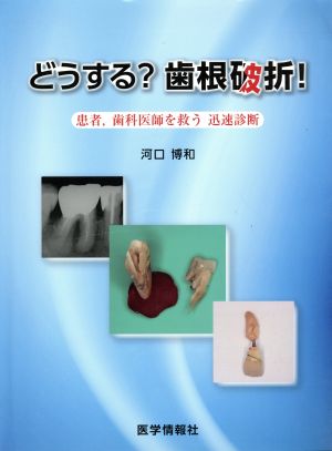 どうする？歯根破折！ 患者,歯科医師を救う迅速診断