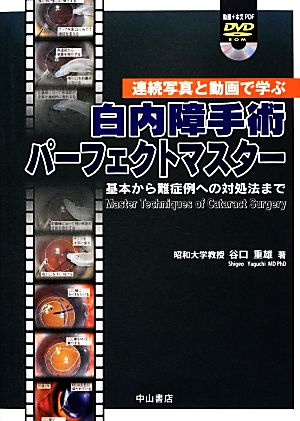 白内障手術パーフェクトマスター 基本から難症例への対処法まで