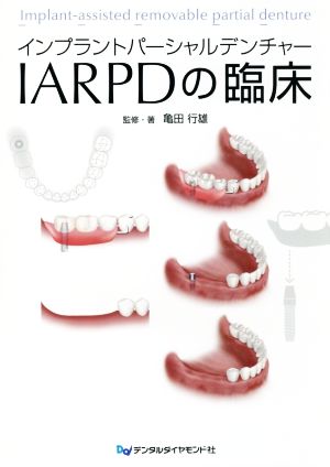 インプラントパーシャルデンチャーIARPDの臨床