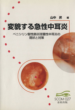 変貌する急性中耳炎 ペニシリン耐性肺炎球菌性中耳炎の現状と対策