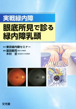 実戦緑内障 眼底所見で診る緑内障乳頭 