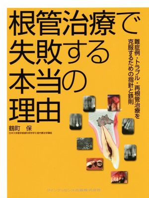 根管治療で失敗する本当の理由 難症例・トラブル・再根管治療を克服するための指針と鉄則