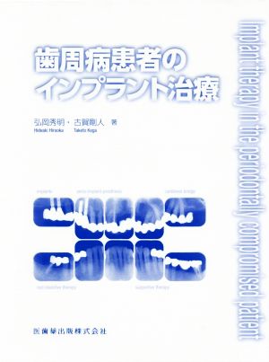 歯周病患者のインプラント治療