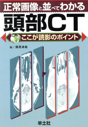 正常画像と並べてわかる 頭部CT ここが読影のポイント