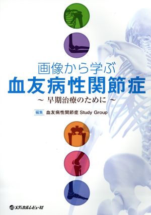 画像から学ぶ血友病性関節症 早期治療のために