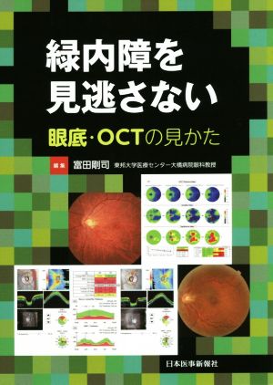 緑内障を見逃さない 眼底・OCTの見かた