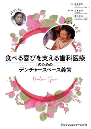 食べる喜びを支える歯科医療のためのデンチャースペース義歯