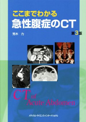 ここまでわかる急性腹症のCT