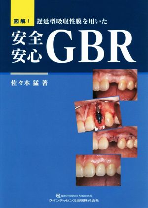 図解！遅延型吸収性膜を用いた安全安心GBR