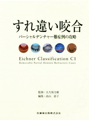 すれ違い咬合 パーシャルデンチャー難症例の攻略