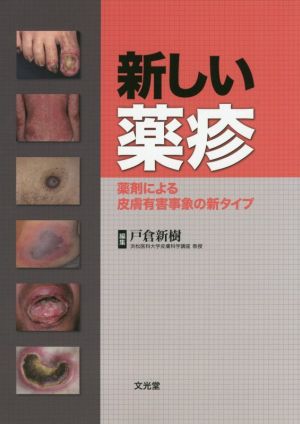 新しい薬疹 薬剤による皮膚有害事象の新タイプ