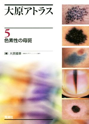 大原アトラス(5) 色素性の母斑