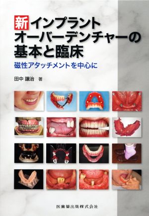 新インプラントオーバーデンチャーの基本と臨床磁性アタッチメントを中心に