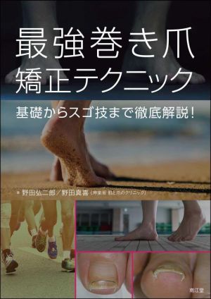 最強巻き爪矯正テクニック 基礎からスゴ技まで徹底解説！