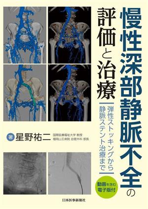 慢性深部静脈不全の評価と治療 弾性ストッキングから静脈ステント治療まで