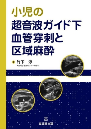 小児の超音波ガイド下血管穿刺と区域麻酔