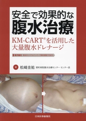 安全で効果的な腹水治療 KM-CARTを活用した大量腹水ドレナージ